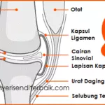 Cara Mengobati Penyakit Rheumatoid Arthritis
